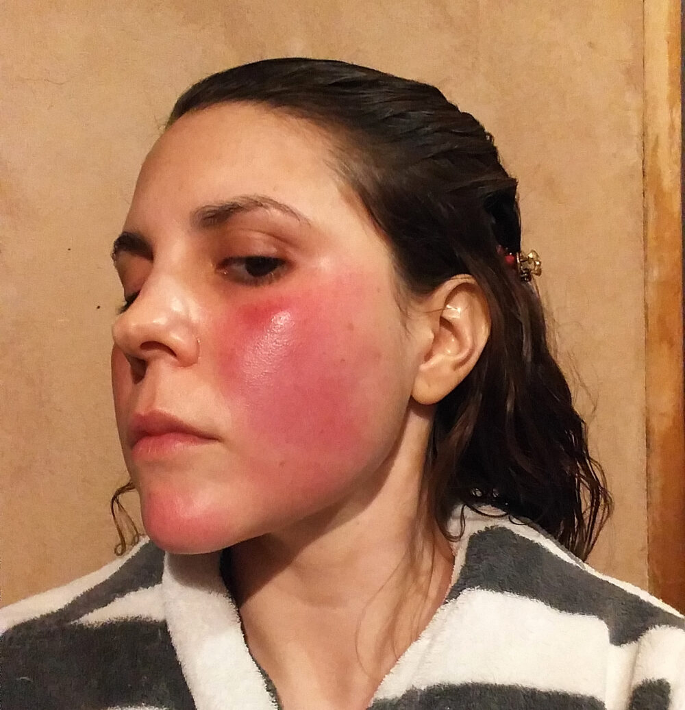 a Woman with Rosacea