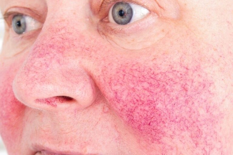 Skin Care Routine for Rosacea